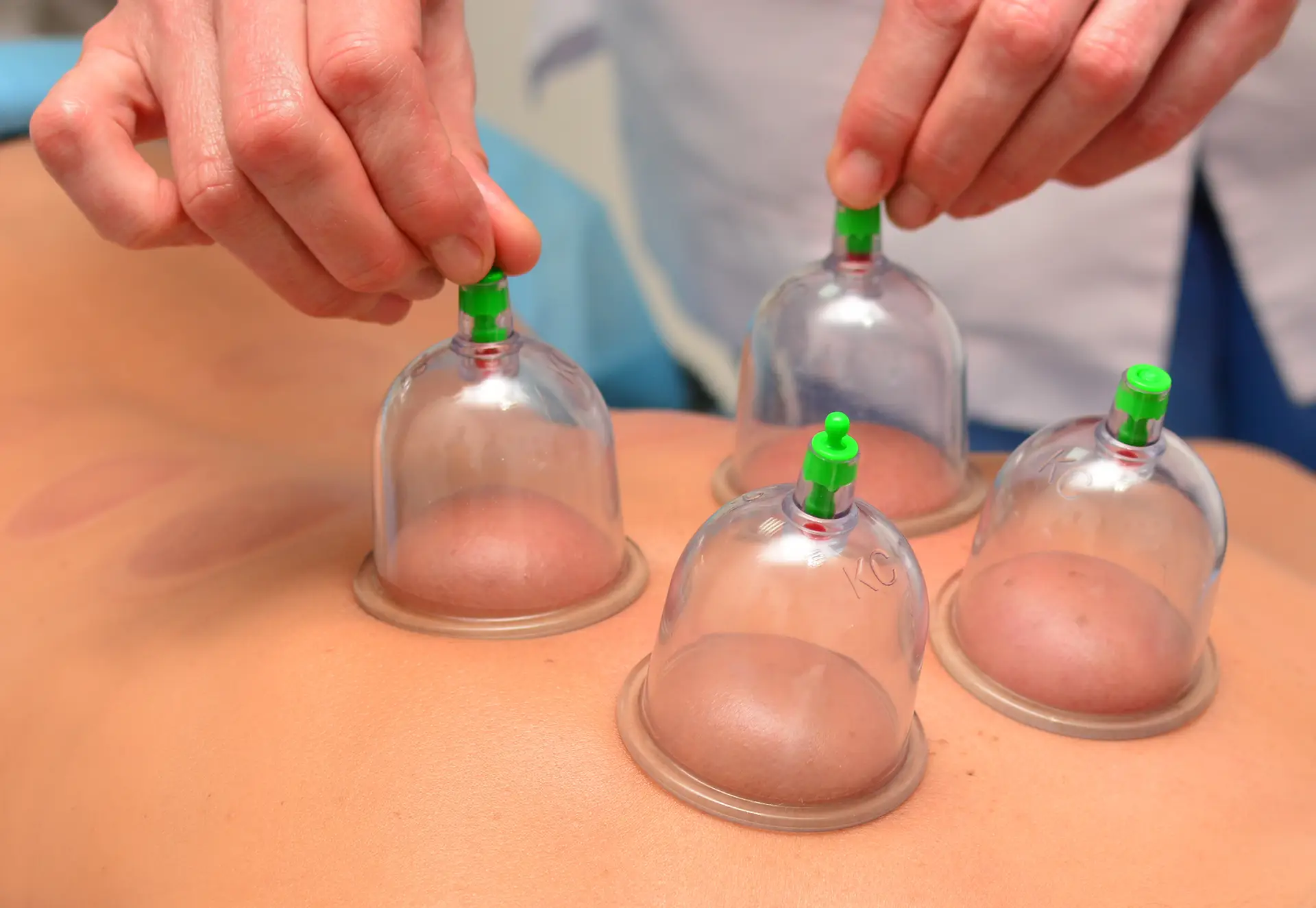 A therapist carefully removing cups from a client’s back, showing marks that are left behind after a cupping session